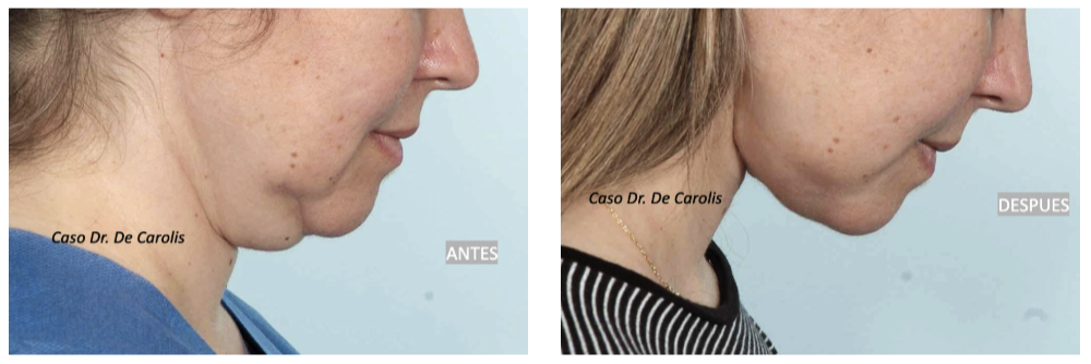 hilos-tensores-cuello-joven-vista-flectada.webp
