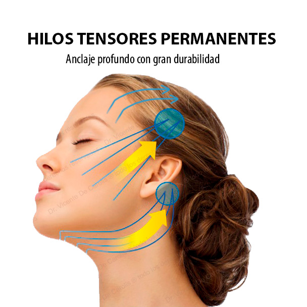Hilos Tensores